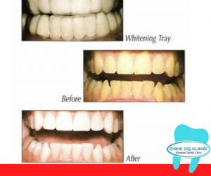 Teeth Whitening